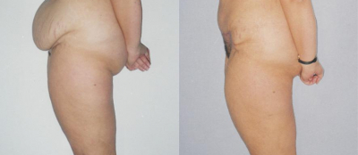 Abdominoplastika - 3