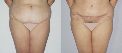 Abdominoplastika - 4