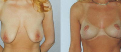 Modelace prsou - 1