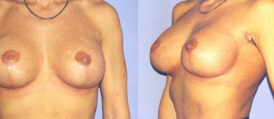 Modelace prsou - 9