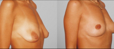 Modelace prsou - 2