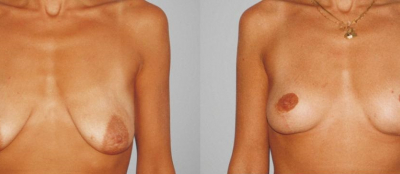 Modelace prsou - 6
